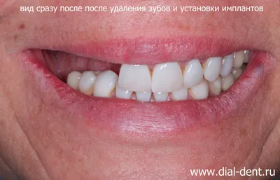 Коронки на зубах занизили прикус и разрушили другие зубы – клиника Smile  STD, Москва