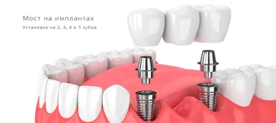 Восстановление зубного ряда посредством коронок – мостовидное  протезирование зубов