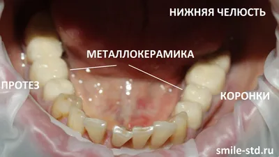 Имплант или мост — что лучше имплантант или мостовидный протез | Dental Art