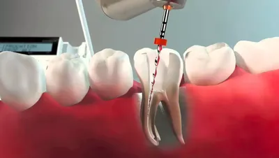 ᐉ Современные методы удаления нерва из зуба