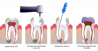 Удаление нерва зуба в Москве 🦷 цена удаления и пломбировки троичного нерва  зуба в стоматологии Lotus Dent