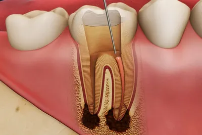 Как убить нерв в зубе: как выглядит, где находится и как можно убить зубной  нерв в домашних условиях?