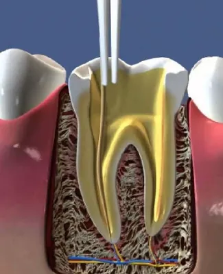 Воспаление зубного нерва | Стоматологическая клиника Слаутинского
