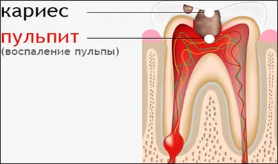 Зубной нерв фото