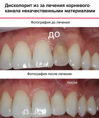 Воспаление зубного нерва при поступлении холодного воздуха - что делать,  если застудил зуб | НоваДент