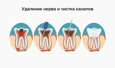 Удаление нерва зуба в ТОП 1 клинике Москвы - Немецкий имплантологический  центр