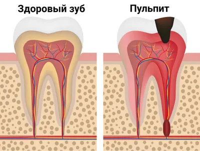 Удаление нерва зуба