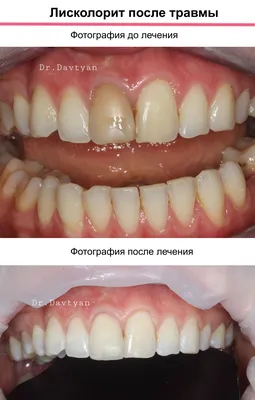 Академия Улыбки • Стоматология Воронеж - ❗️Мёртвым считается тот зуб, у  которого нерв перестал функционировать или вовсе был удалён. - ❤️Зуб без  нерва не получает питания, поэтому становится более хрупким и подверженным