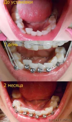 Прорезывание зубов — 2 ответов | форум Babyblog