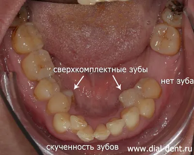 Прорезывание молочных зубов у детей — Gorstom