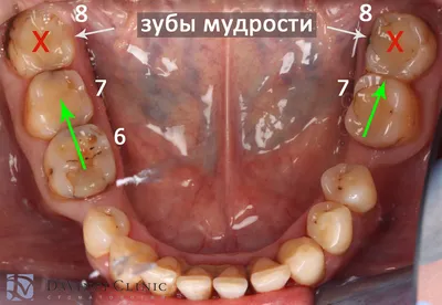 8 ЗУБОВ ЗА 2 ЧАСА | MegaDentadeti