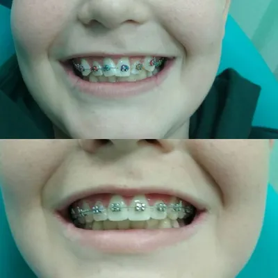 Зубы в 2 месяца фото