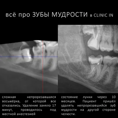 Помощь при прорезывании зубов – статьи детской стоматологической клиники  «Мартинка»