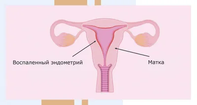 Почему мы не можем вылечить кандидоз - Постоянная молочница: причины и  лечение