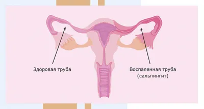 Лечение кандидоза у женщин: как и чем лечат, методы и подходы