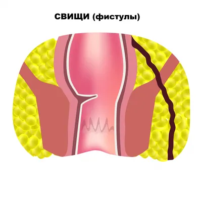 Боль в заднем проходе - причины появления, при каких заболеваниях  возникает, диагностика и способы лечения