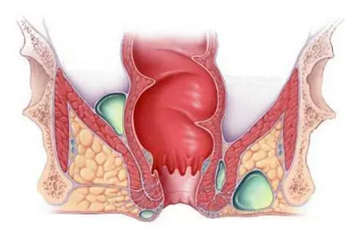 Парапроктит: коварный свищ и ложный стыд - KP.RU